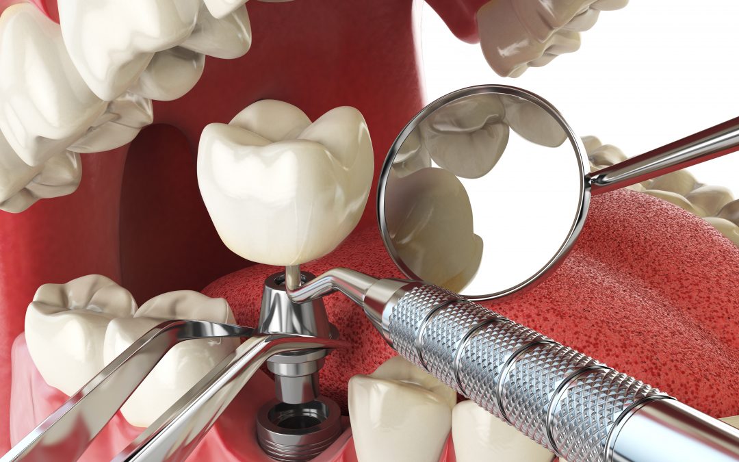 Is an implant the best option for me?